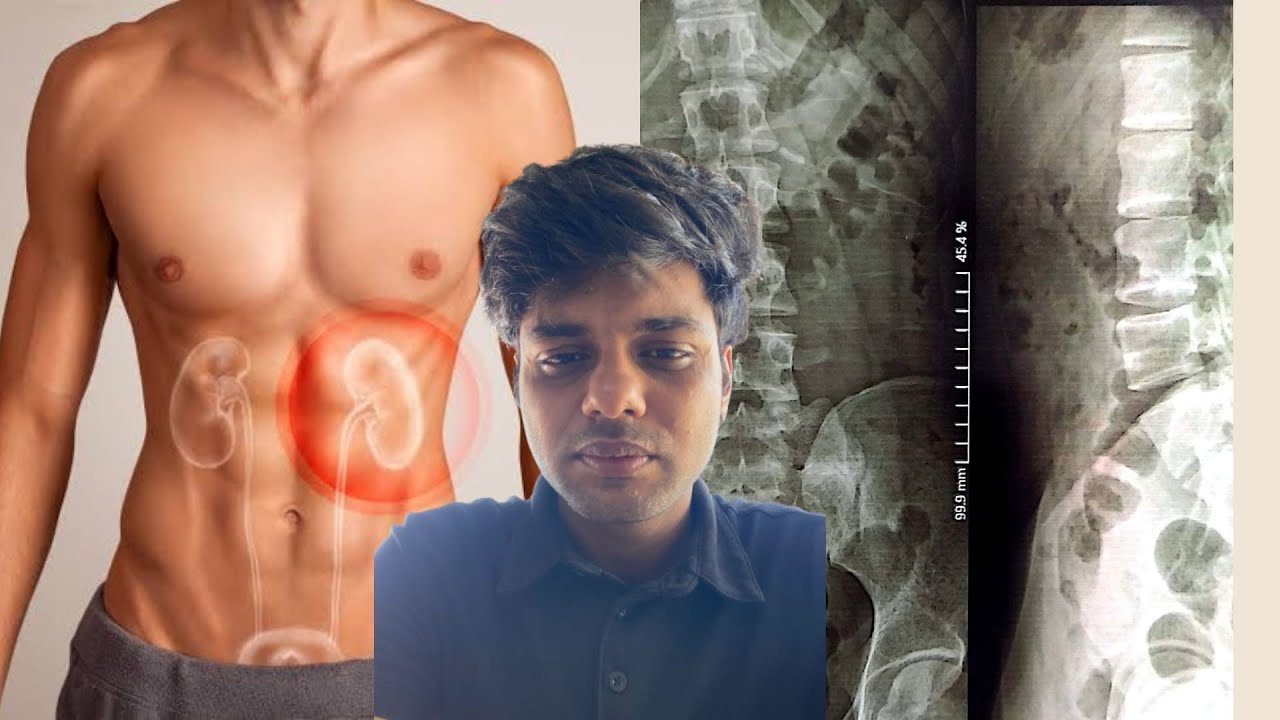 My kidney and heart have problem #deaf #deafcommunity #signlanguage #youtube #deafworld #deafindia 