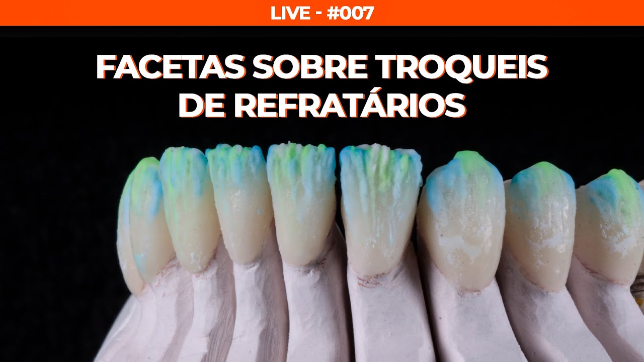 FACETAS COM CERÂMICA FELDSPÁTICA SOBRE TROQUEIS DE REFRATÁRIO - LIVE #007