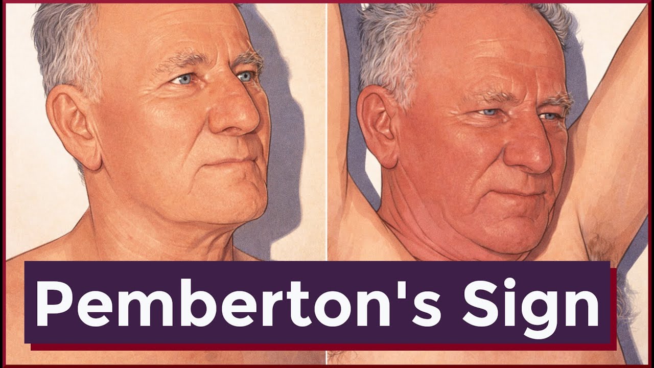 Pemberton's Sign | Thoracic Inlet Syndrome