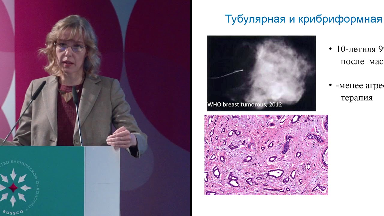 Специфические подтипы рака молочной железы. Веретеноклеточные опухоли молочной железы