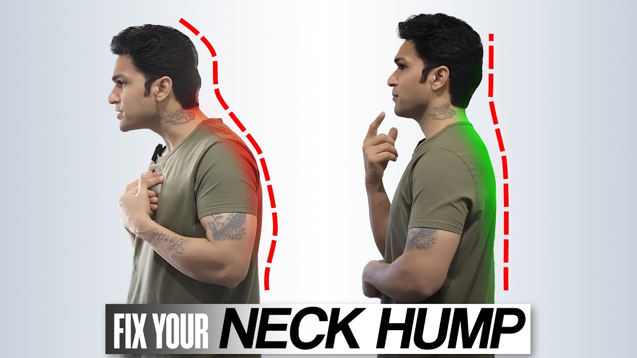 How to Fix Neck Hump? Causes, Problems & Simple Solutions Explained!
