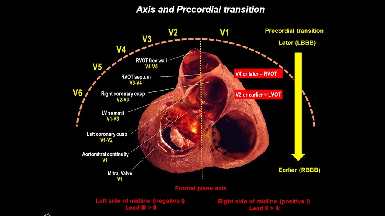 Expert Perspective with Andres Enriquez, MD: Predicting Ventricular Arrhythmias with 12-Lead ECG