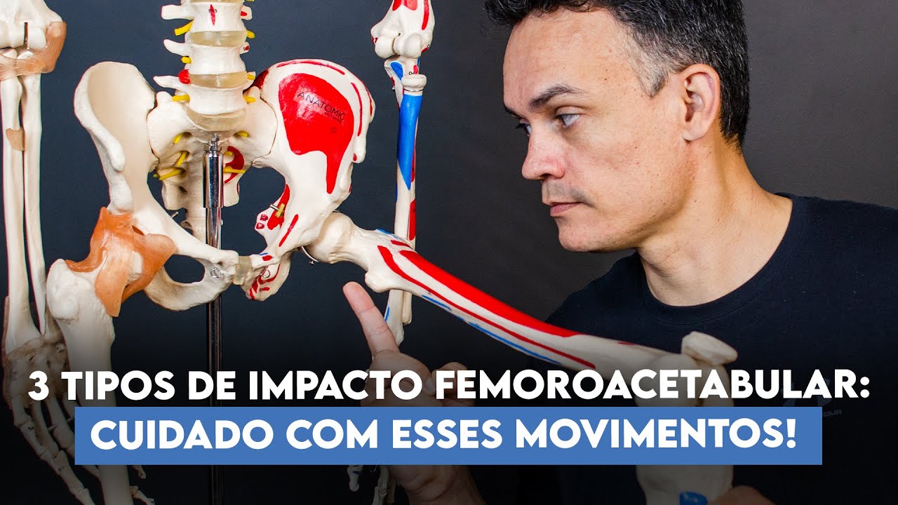3 tipos de impacto femoroacetabular e cuidados que você deve ter com movimentos nessa articulação