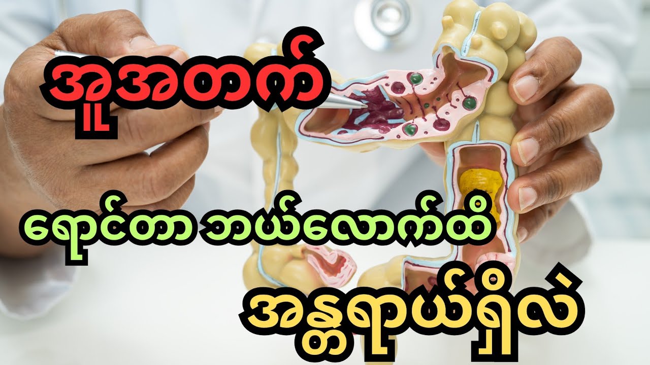 အူအတက်ရောင်တာ ဘယ်လောက်ထိ အန္တရာယ်ရှိလဲ - appendicitis