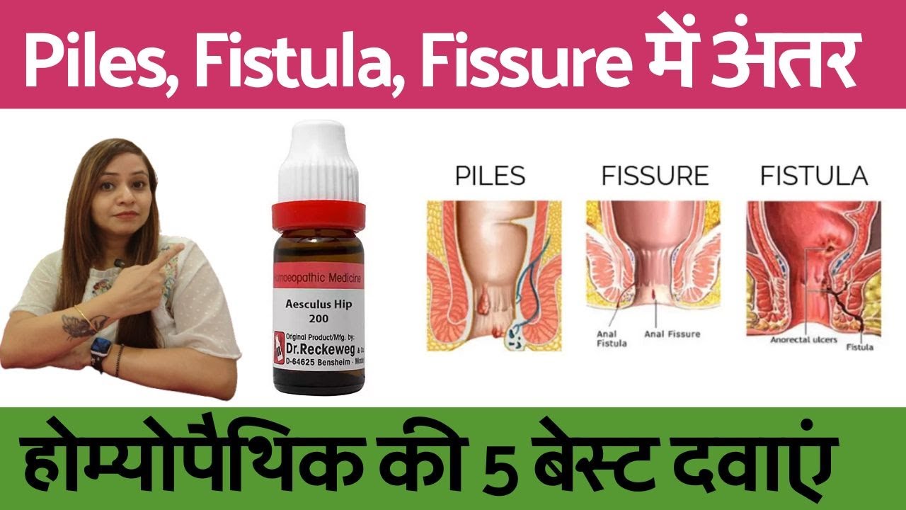 बवासीर, भगन्दर, फिसर में अंतर और लक्षण | piles fissure fistula symptoms & homeopathic medicine