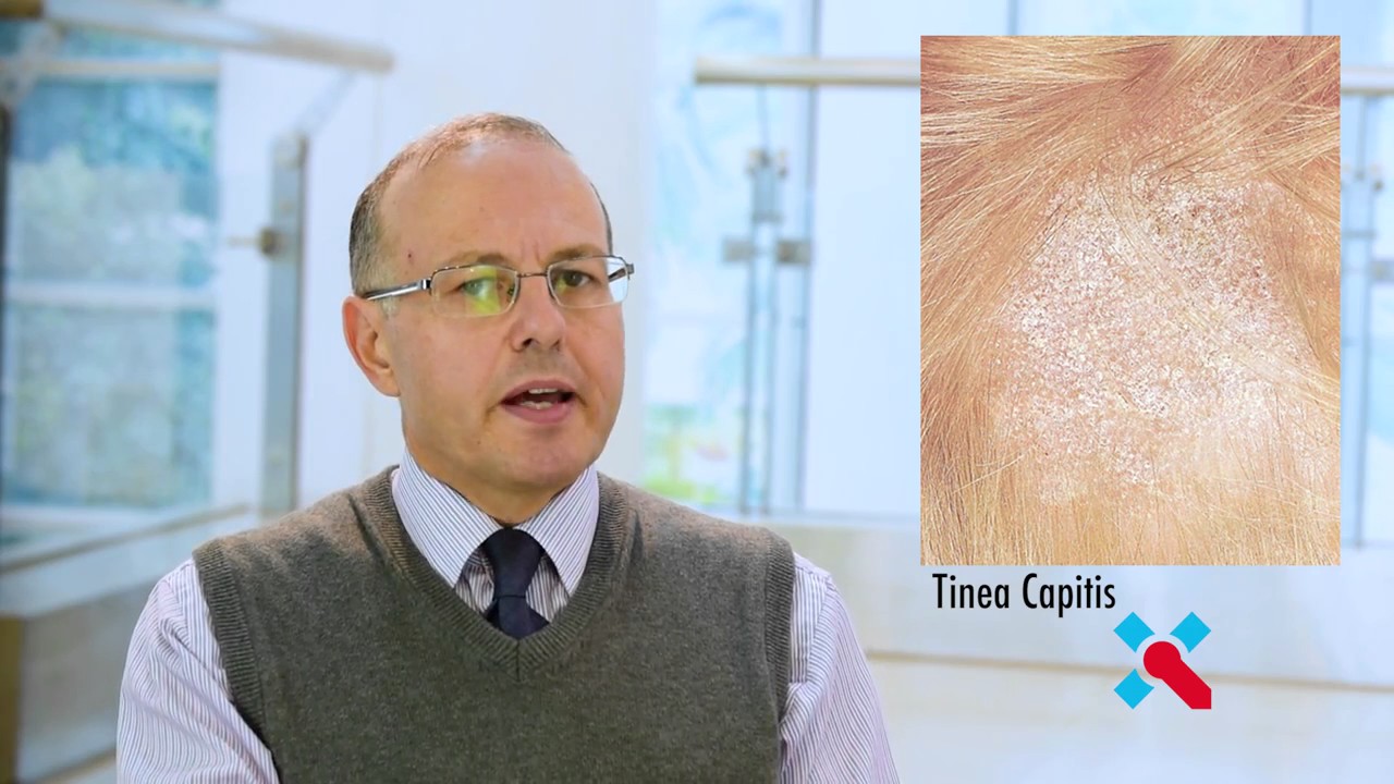 Common Skin Fungal Infections