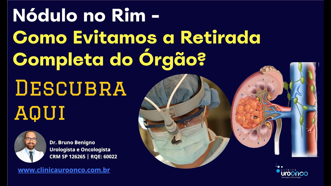 Nódulo no Rim | Como Tratamos e Evitamos a Retirada completa do Órgão. Informe-se antes da Cirurgia