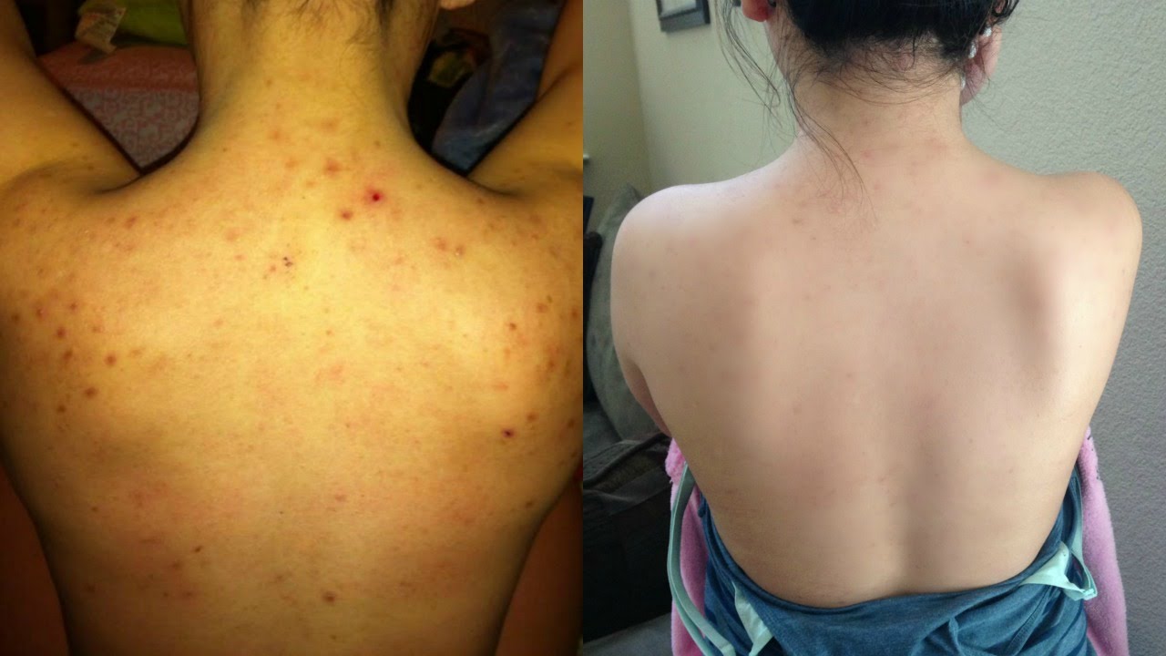 How I Cleared My BACNE! + Easy and Afforadable DIY Masks