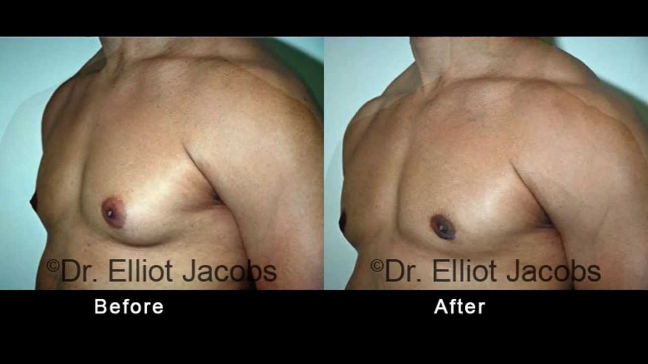 Gynecomastia New York (NYC) - Body Builder Before and After Photos