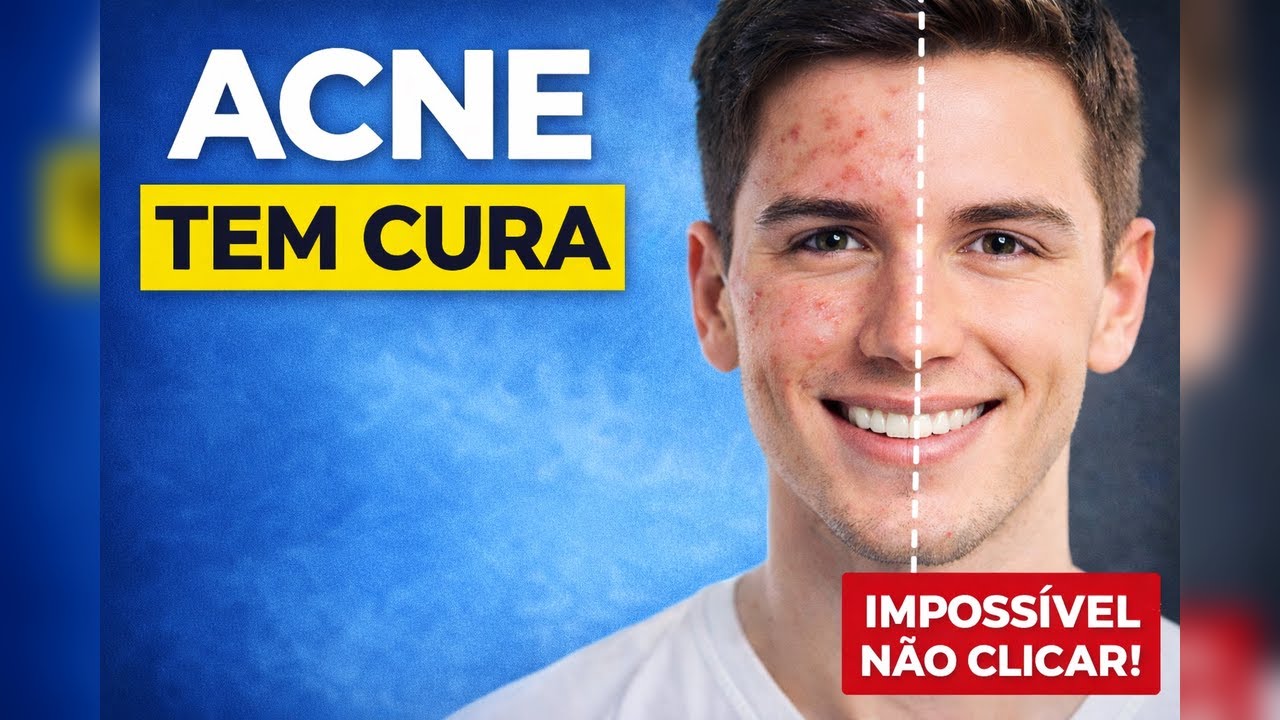 Acne (espinhas) tem cura! Tratamento com isotretinoína. Por Luiz Gameiro, dermatologista