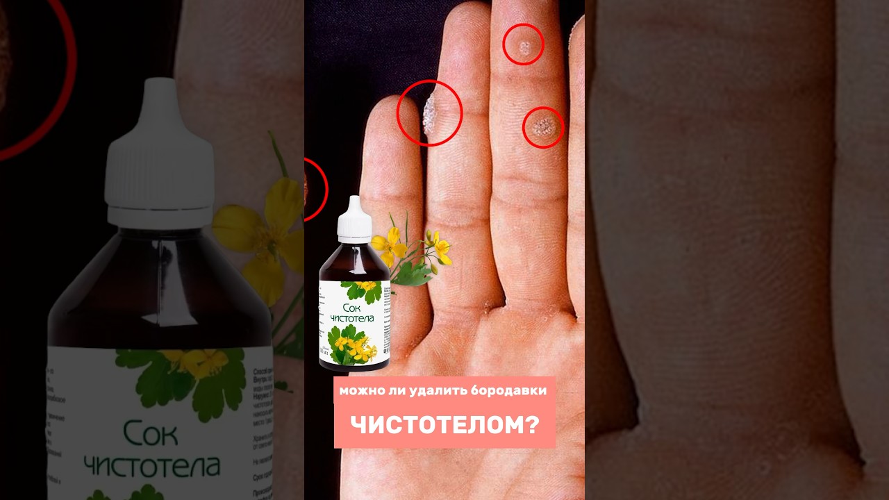 Бородавки и папилломы: удаление чистотелом. Это ОПАСНО?