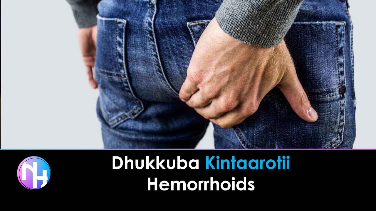 AAFIYAA: Dhukkuba Kintaarotii/Hemorrhoids