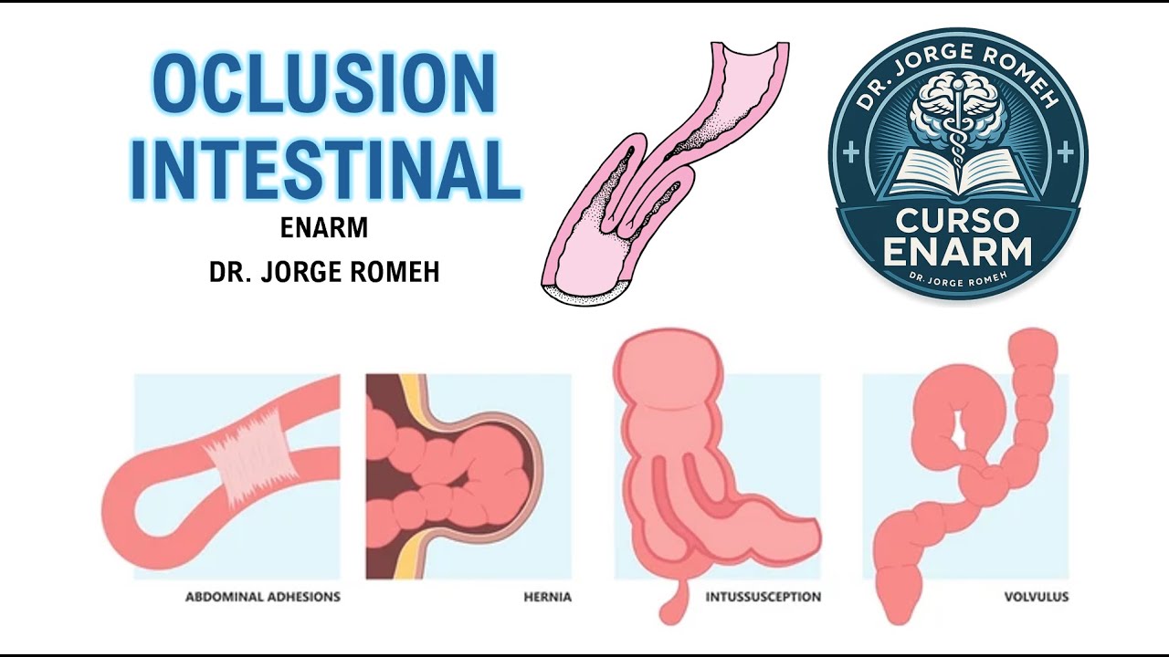 OCLUSION INTESTINAL - ENARM - TODO LO QUE HAY QUE SABER