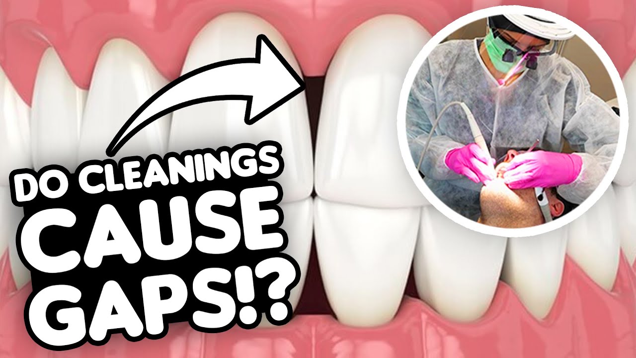 Can Dental Cleanings Cause Gaps Between Teeth? (Black Triangles Explained)