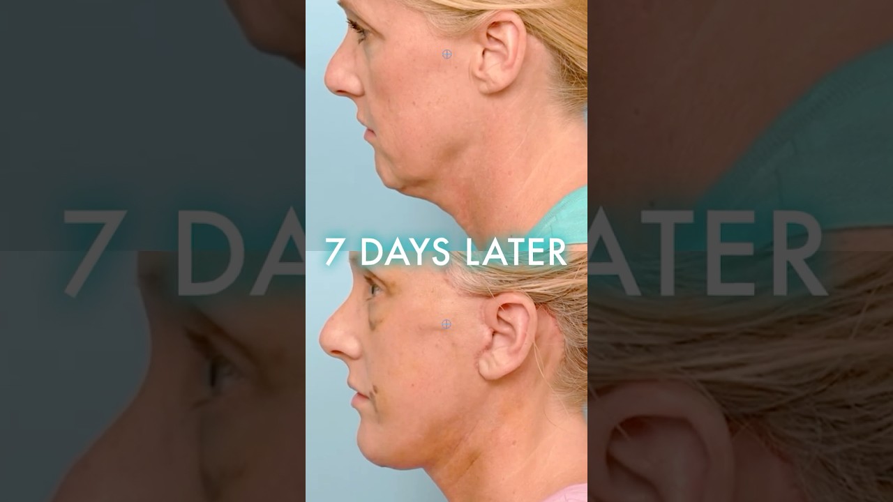 She Got a Facelift and Brow Lift &mdash; Here&rsquo;s How She Looks 7 Days Later #FaceliftBeforeAndAfter
