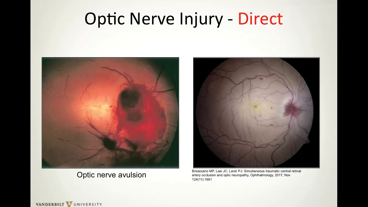 Trauma of the Posterior Segment