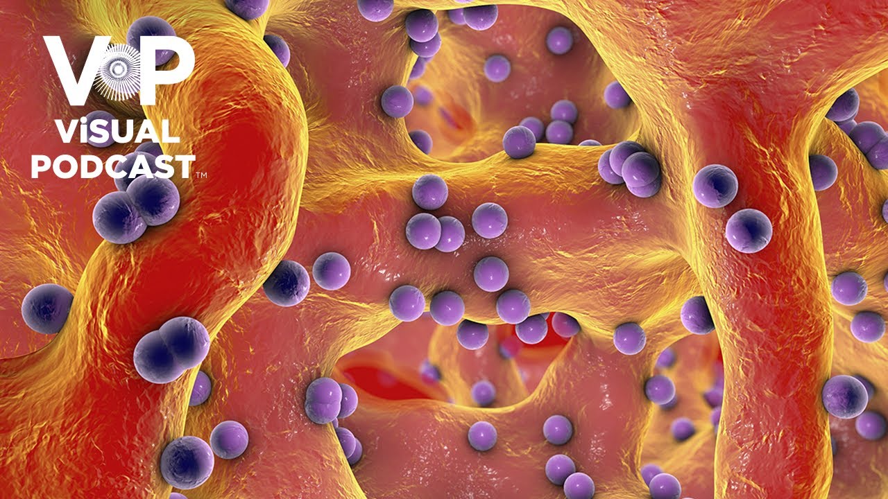 Osteomyelitis: Achieving Antibiotic Penetration