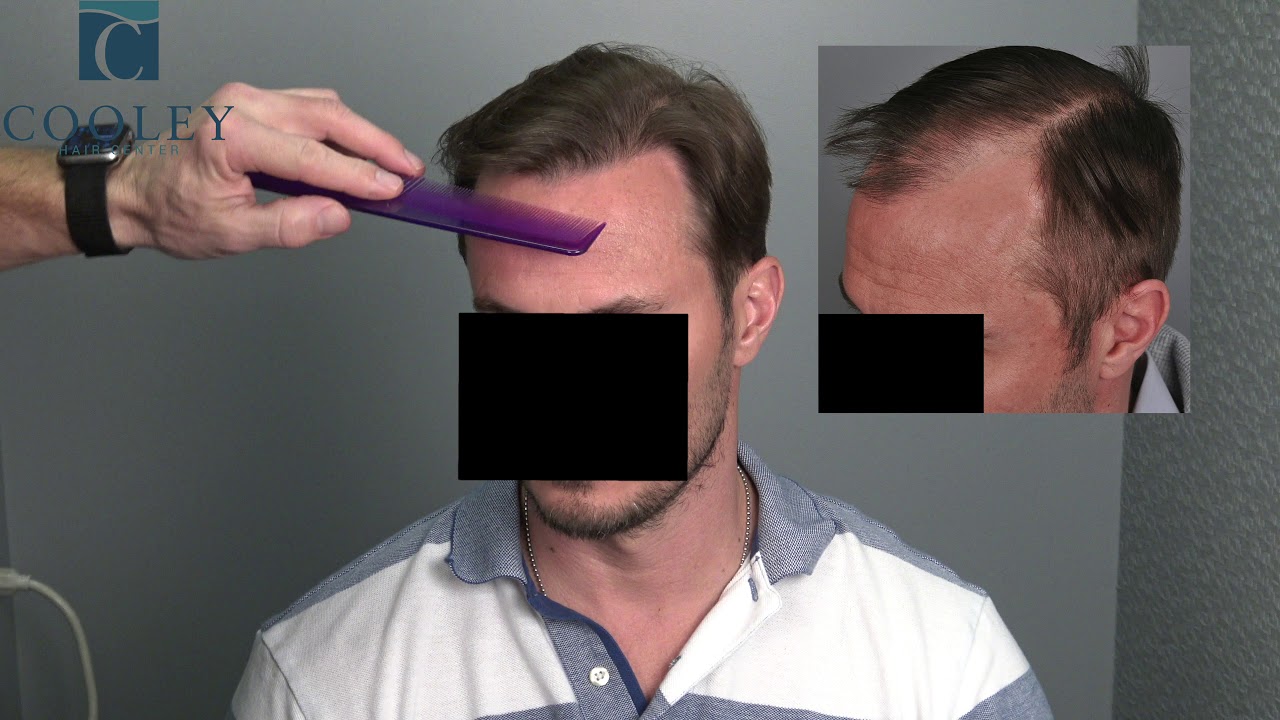 Hair Transplant FUT 3241- Jerry Cooley MD-Cooley Hair Center
