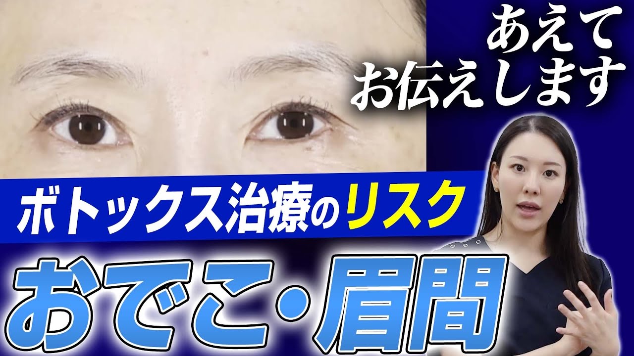 おでこ、眉間のボトックス治療のリスクについて解説します。