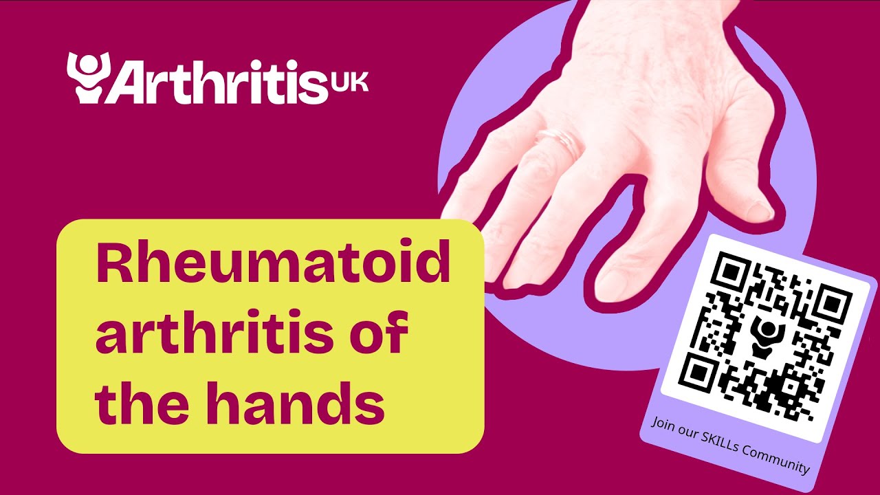 Rheumatoid arthritis of the hands