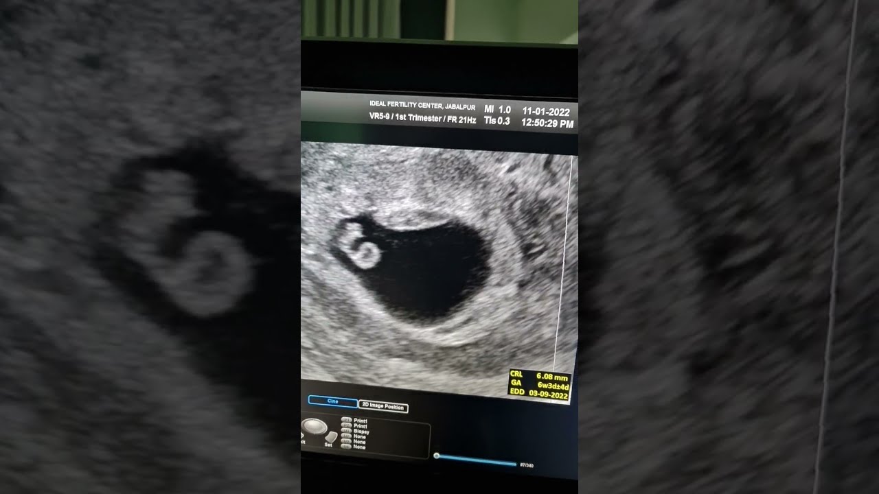 Twin Pregnancy, Low AMH, Fibroid, severe endometriosis, own eggs. 39yr.