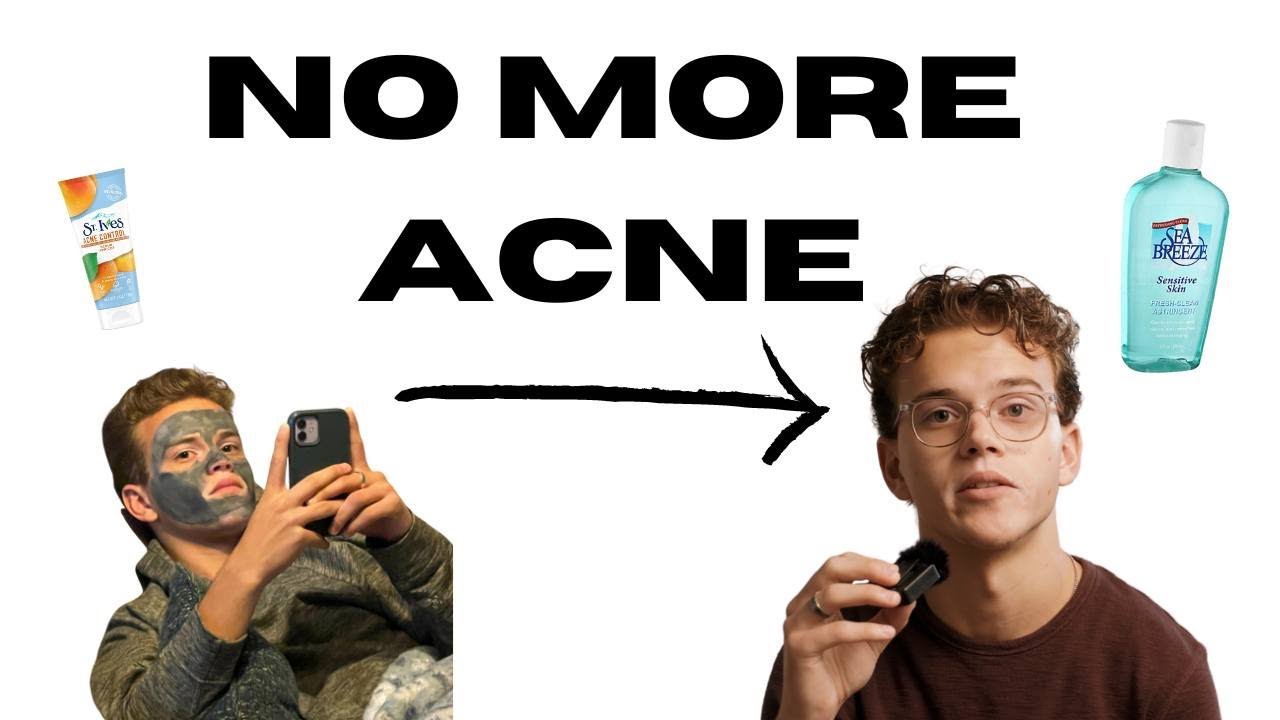 Accutane fixed my skincare and acne problems