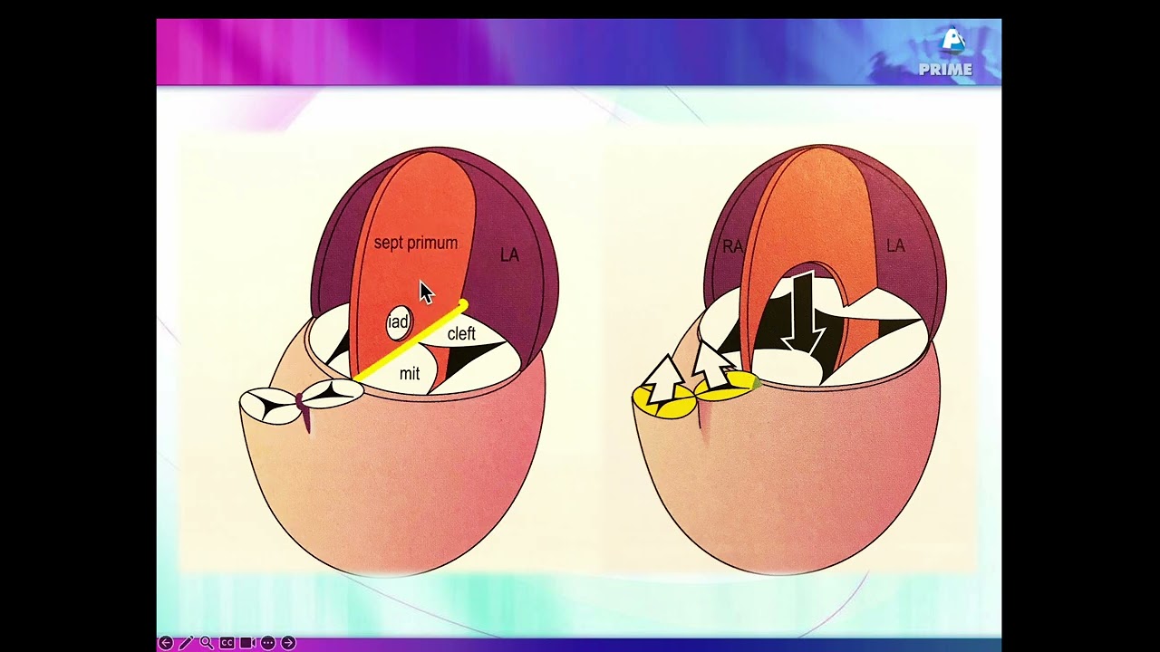 Detecting Atrial Septal Defects on Fetal Echo: What You Can and Can't See!