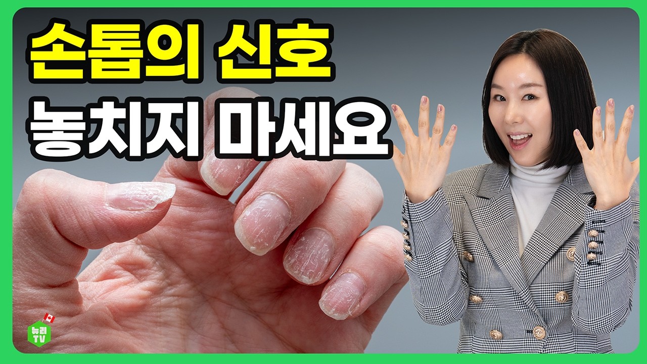 손톱 세로줄·부러짐, 단순히 나이 탓 아닙니다 (철분·아연·비오틴 부족 신호)