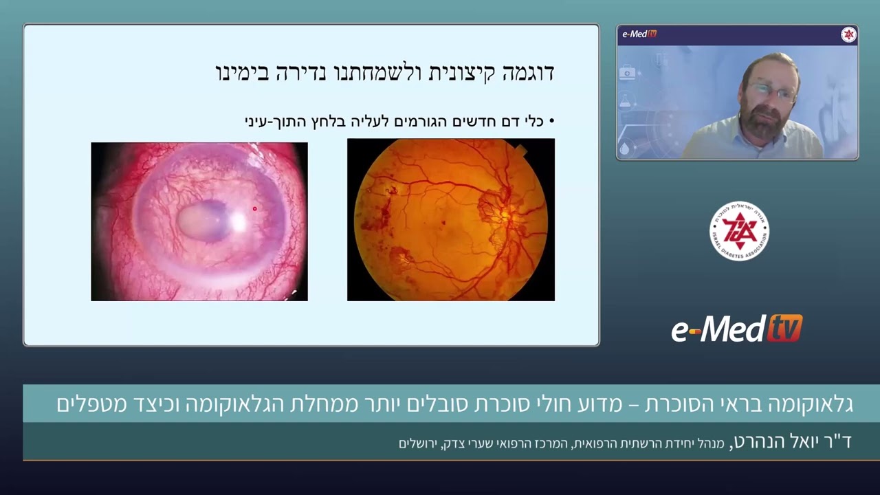 גלאוקומה בראי הסוכרת - מדוע חולי סוכרת סובלים יותר ממחלת הגלאוקומה וכיצד מטפלים, ד
