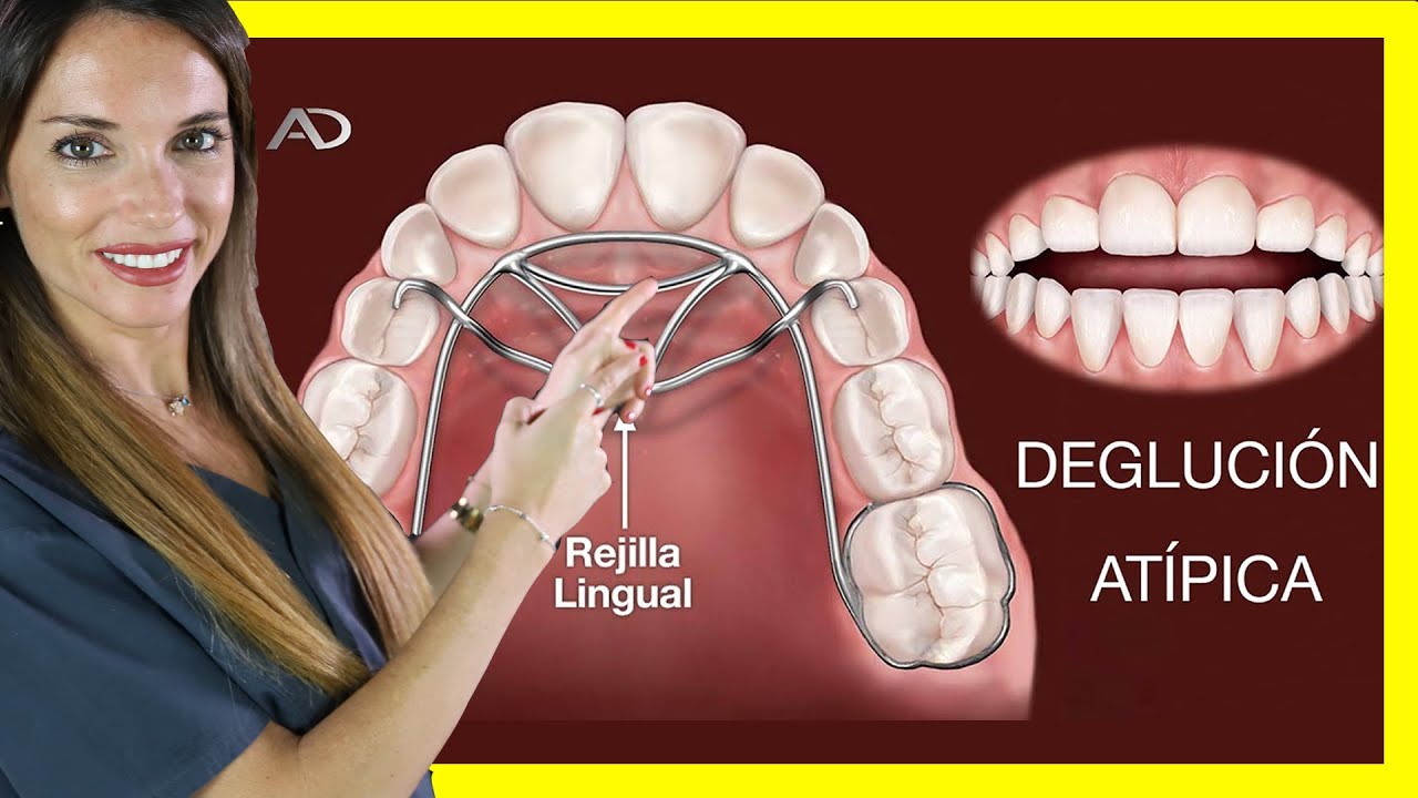 DEGLUCION ATIPICA ORTODONCIA, CERRAR  MORDIDA ABIERTA CON ORTODONCIA, REJILLA LINGUAL Y BRACKETS