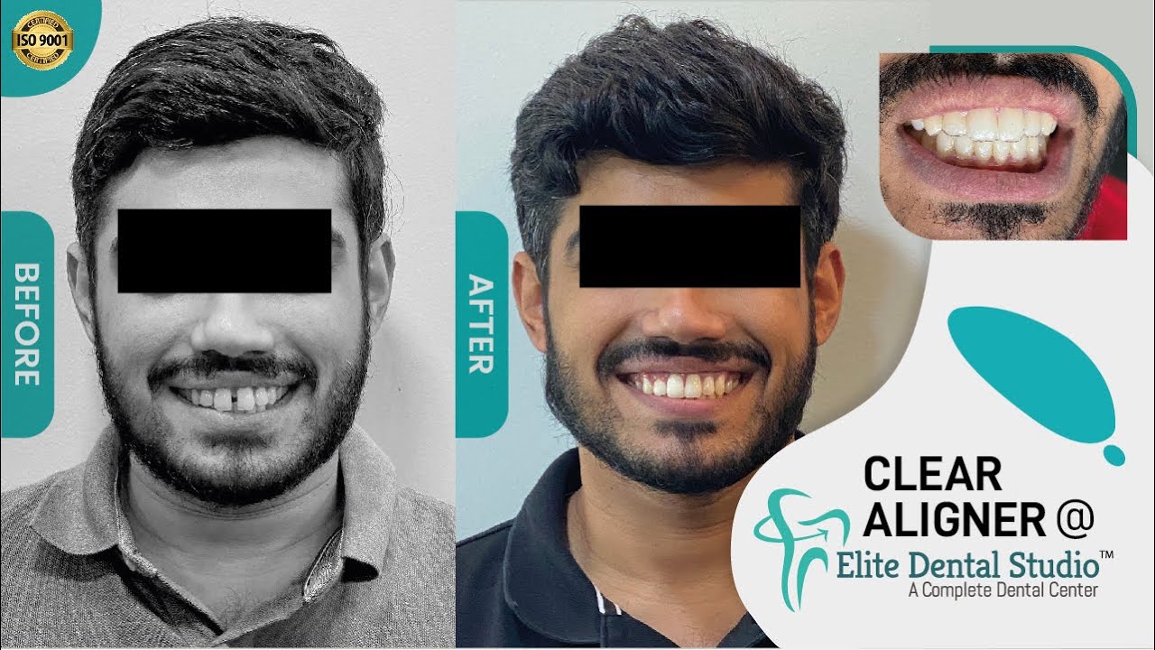| CLEAR ALIGNERS | | ELITE DENTAL STUDIO | | PATIENT TESTIMONIALS | | Mr. THARIQ YOUSEF |