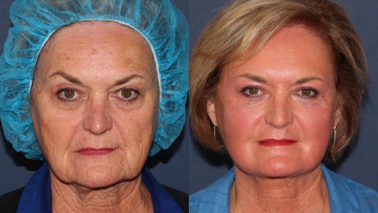 Take 10 Years off your Face and Neck with ONE Treatment