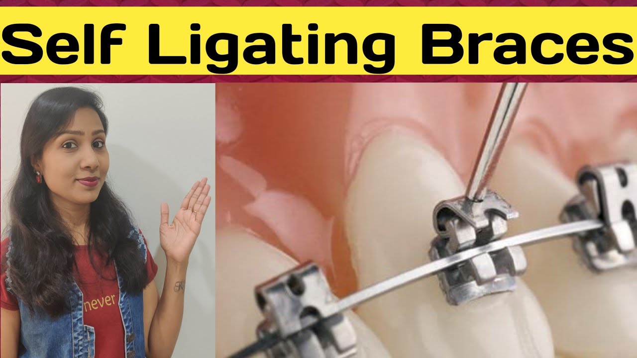 Self Ligating Braces |Vs Regular Braces |Damon System Braces |Braces cost