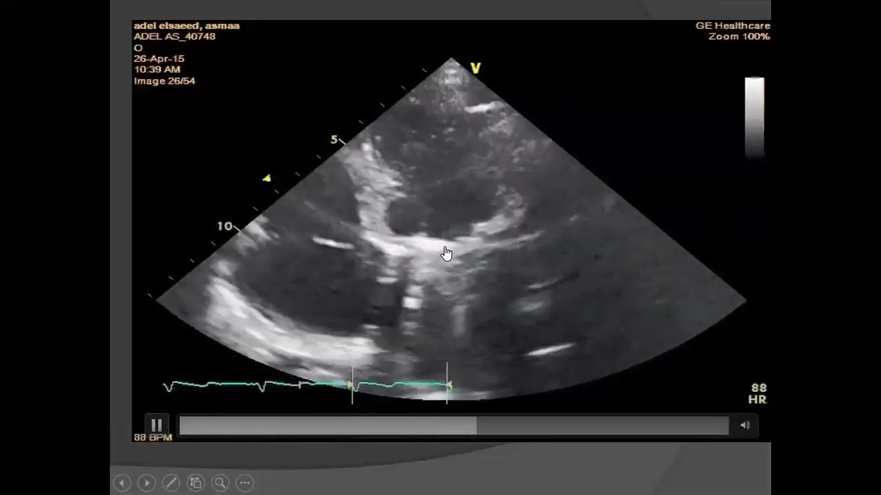 echo conference 3 -1-2024, MV prosthesis
