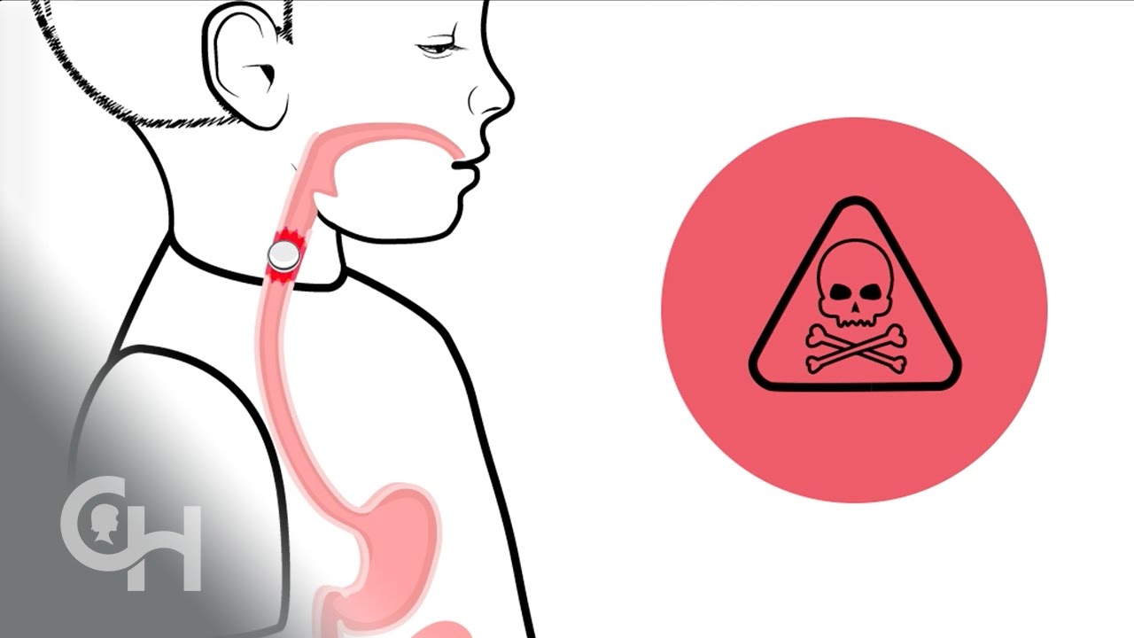 Button Batteries: A Danger to Children