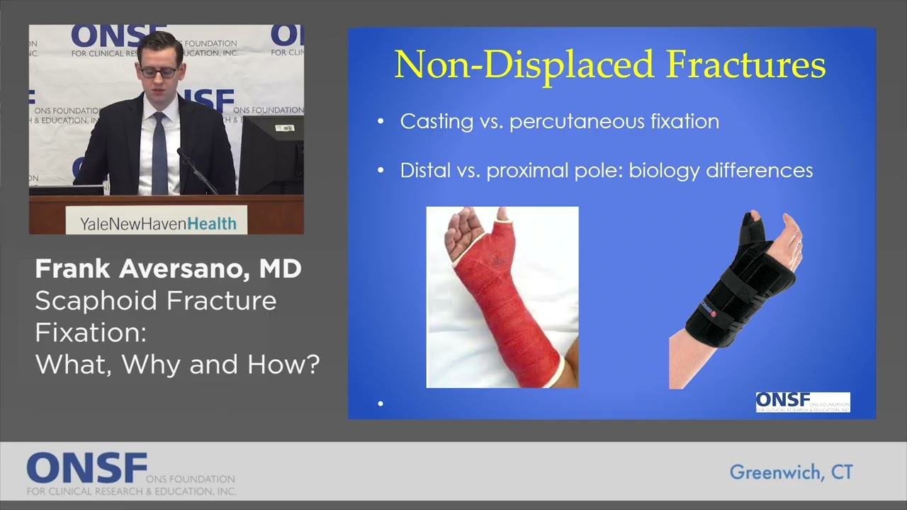 Frank Aversano, MD -  Scaphoid Fracture Fixation:  When, Why and How?