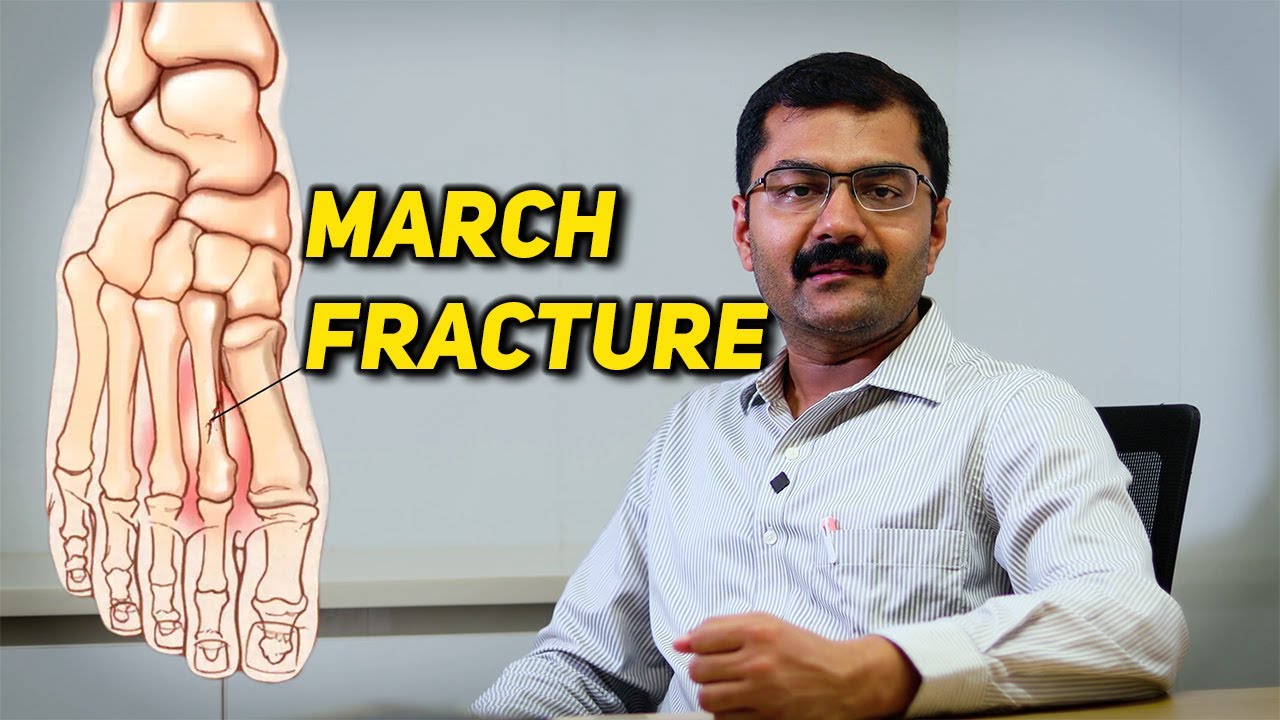 March Fracture Dr. Soundar