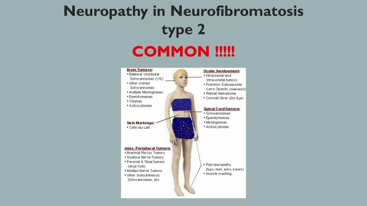 Neuropathy in NF2 by Anke Hensiek