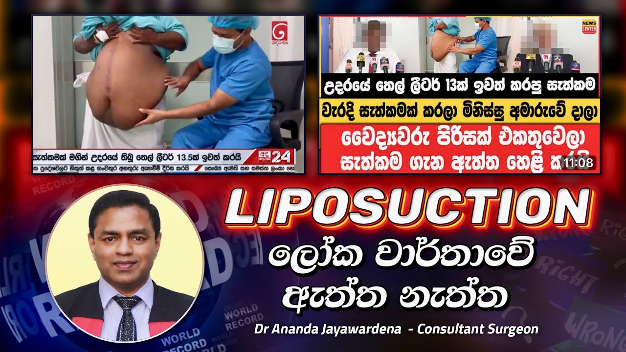 ලීටර් 13.5 Liposuction ඇත්ත නැත්ත World record by Dr Ananda Jayawardena The truth about media news