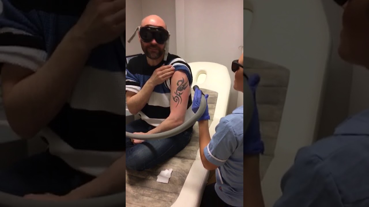 Sykepleier Jon fjerner sin egen tatovering
