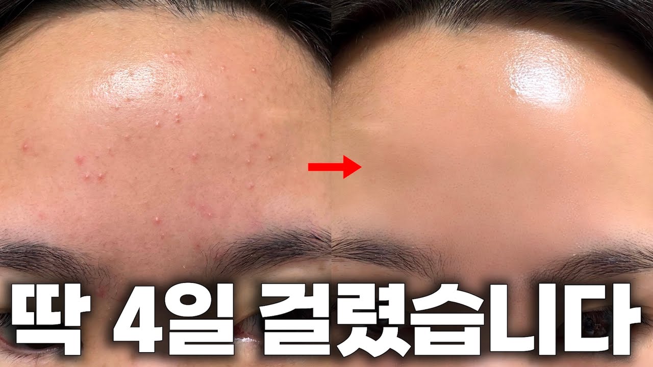 광고❌ only 홈 케어,  단돈 1000원, 하루 딱 20분 | 여드름, 속건조, 유수분밸런스 다 잡는 방법