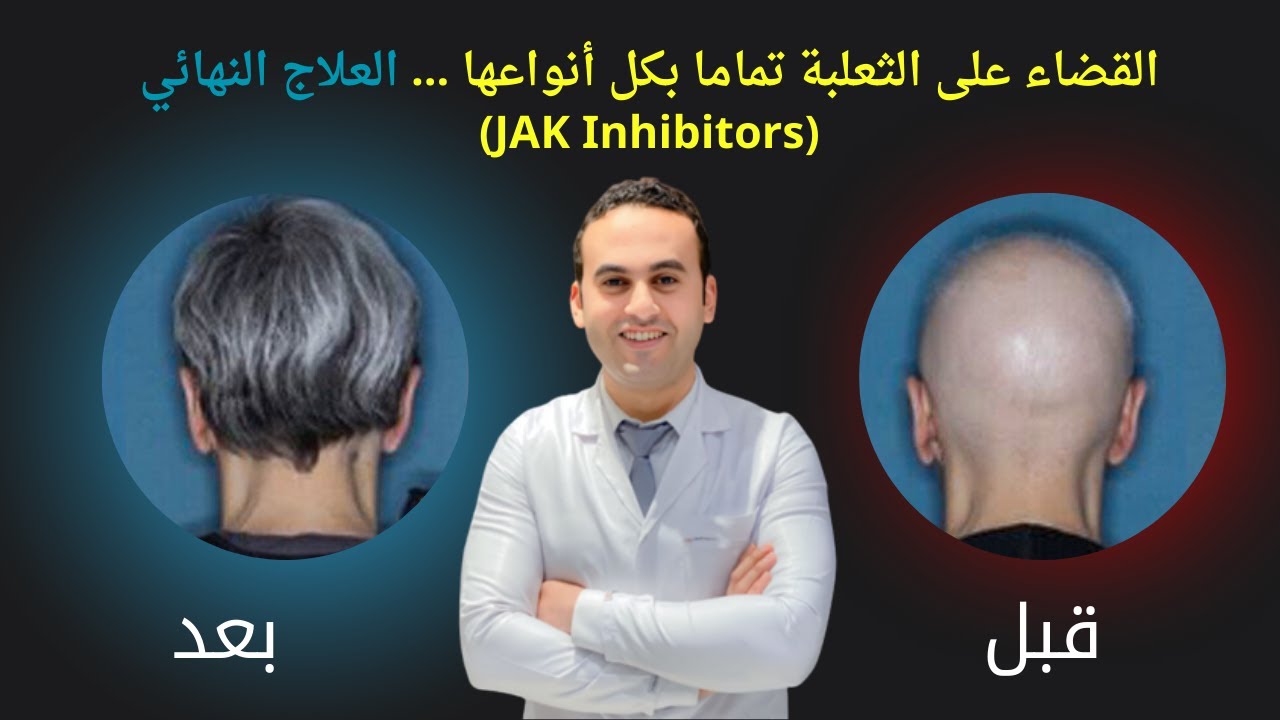 الأحدث ||  العلاج النهائي والقضاء على الثعلبة تماما بكل أنواعها 🫶❤️ (JAK Inhibitors)