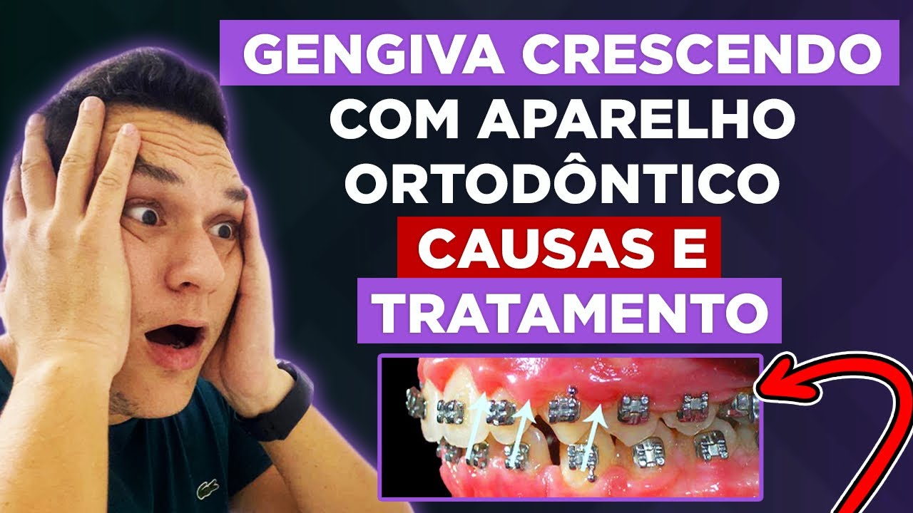 GENGIVA CRESCENDO COM APARELHO ORTODÔNTICO | CAUSAS E TRATAMENTO!