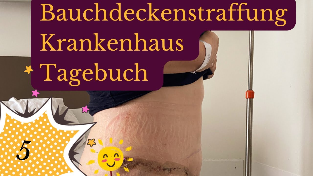 Bauchdeckenstraffung Krankenhaus Tagebuch nach abnehmen