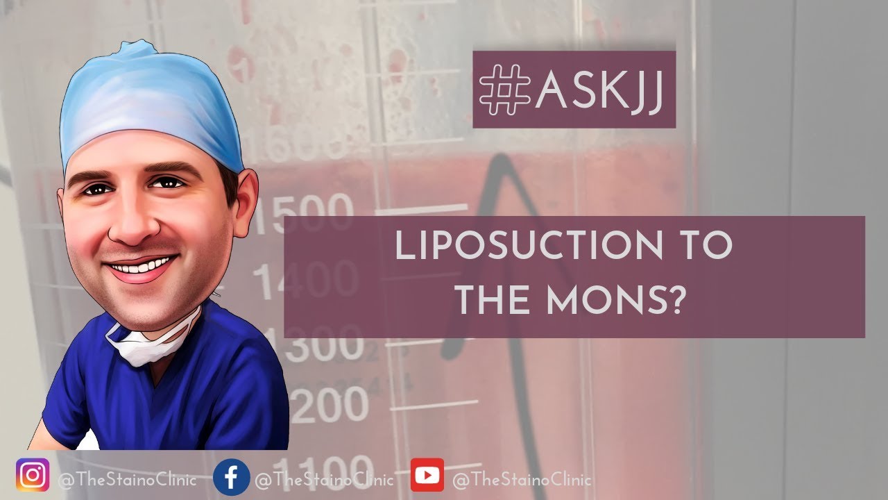 Does the pubic hair move up when having liposuction to the mons?