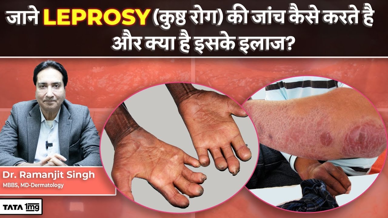 जाने Leprosy (कुष्ठ रोग) की जांच कैसे करते है और क्या है इसके इलाज? | Tata 1 MG
