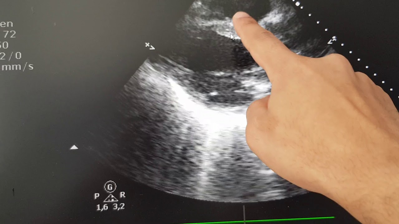 የልብ አልትራሳውንድ በአማርኛ Echocardiography basics in Amharic