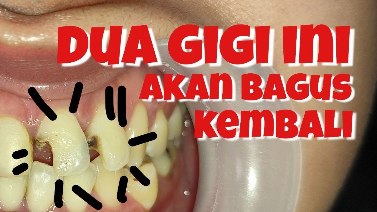 GIGI DEPAN RUSAK ??? KITA PERBAIKI.. TOOTH BROKEN RESTORATION