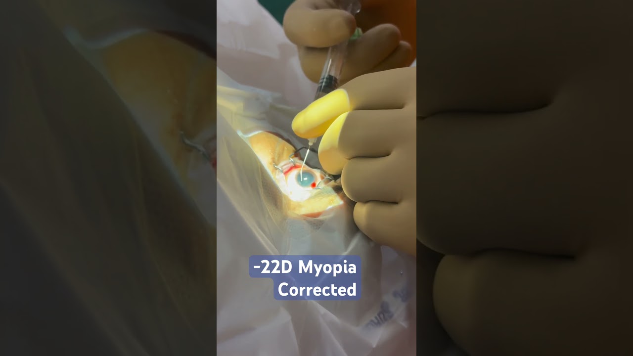 -22 D Myopia corrected I Eye Means SunEye # Myopia #suneyecafe