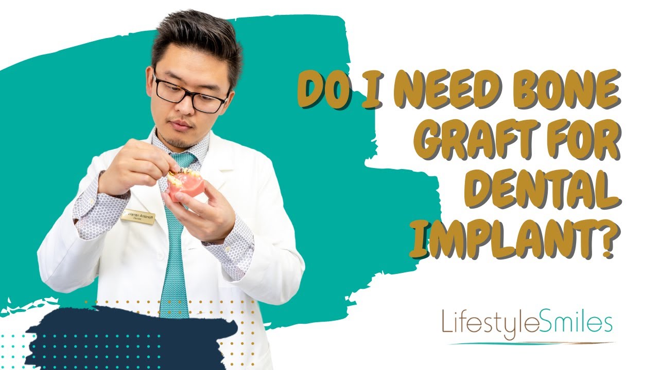 Do I Need Bone Graft for Dental Implant?
